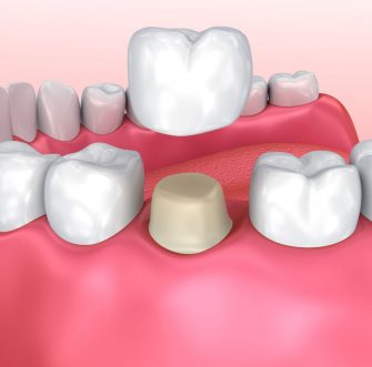 Treatment - 112dental