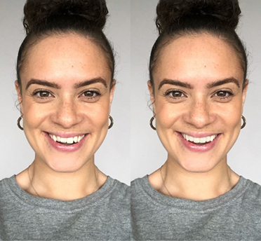 Teeth Before and After – Invisalign Treatment