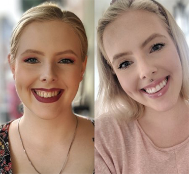 Teeth Before and After – Invisalign Treatment