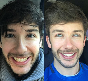 Teeth Before and After – Invisalign Treatment