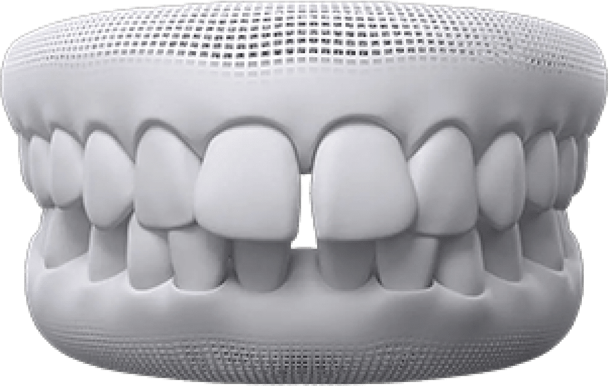 Gaps Between Teeth Treatment