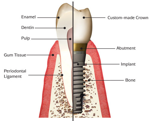 a dental implant diagram